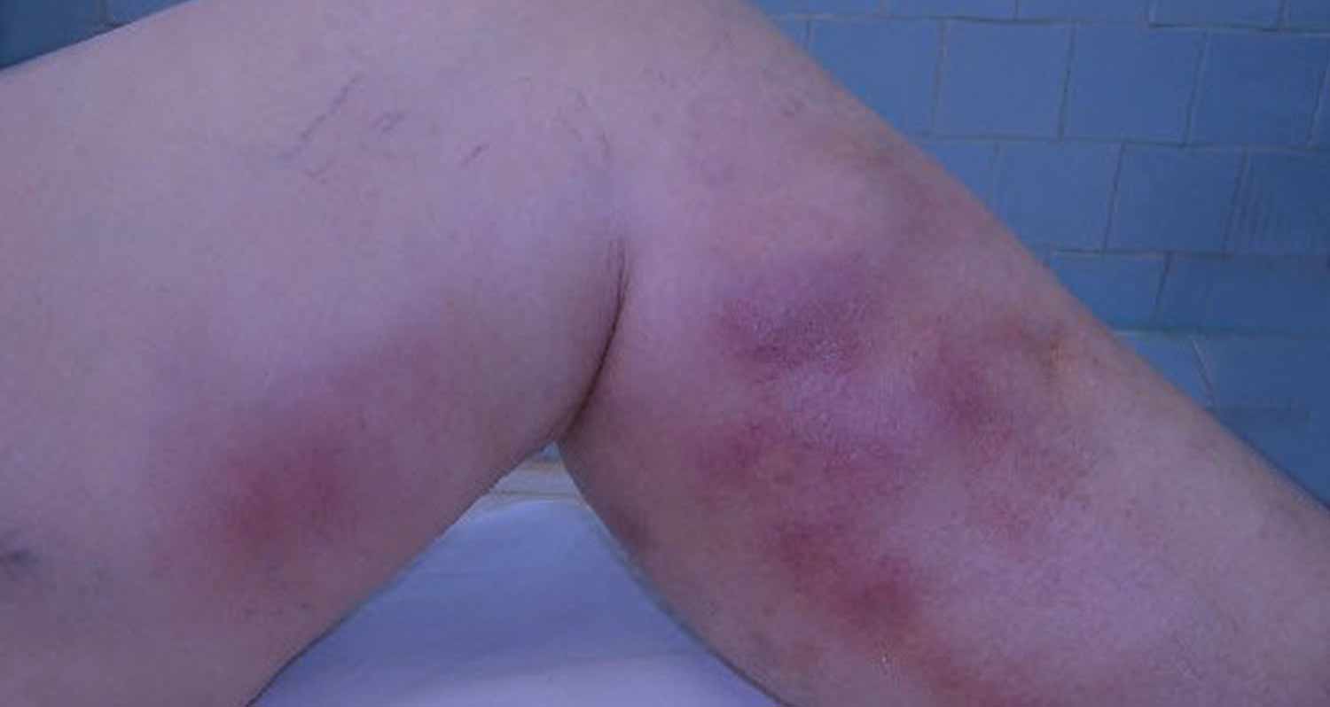 površinsi-tromboflebitis